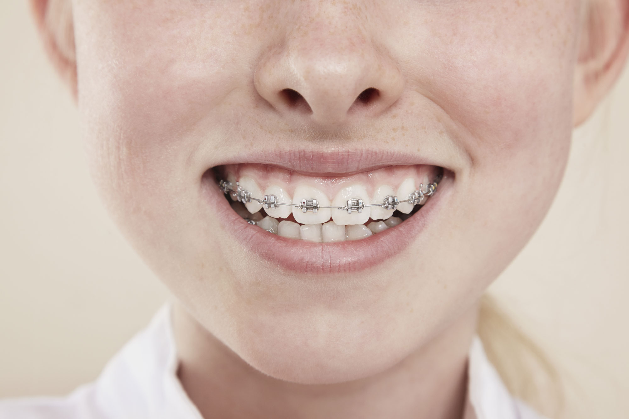 Why the DIY Braces Trend is Seriously SO Dangerous